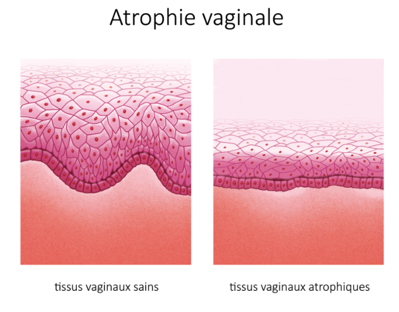 Atrophie Vaginale