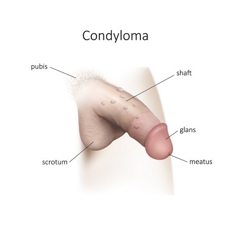 Excision and fulguration of condyloma (genital warts)