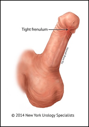 tight frenulum