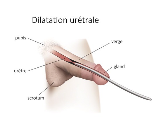 Dilatation du méat urinaire