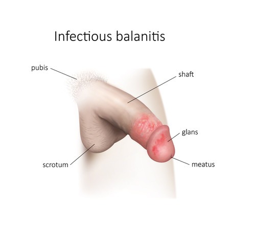 Infectious balanitis