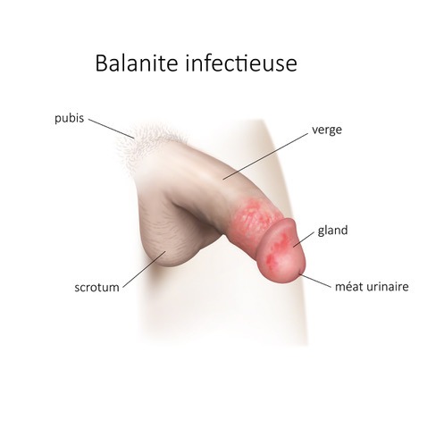 Balanite infectieuse