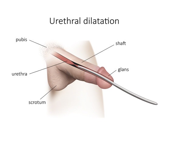 Urethral dilatation