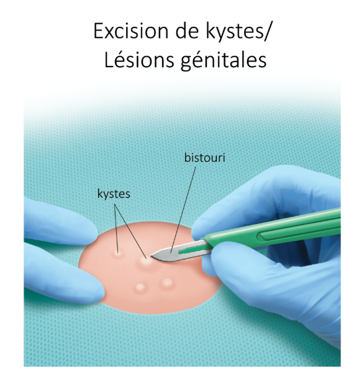 excision de kystes - lésions génitales