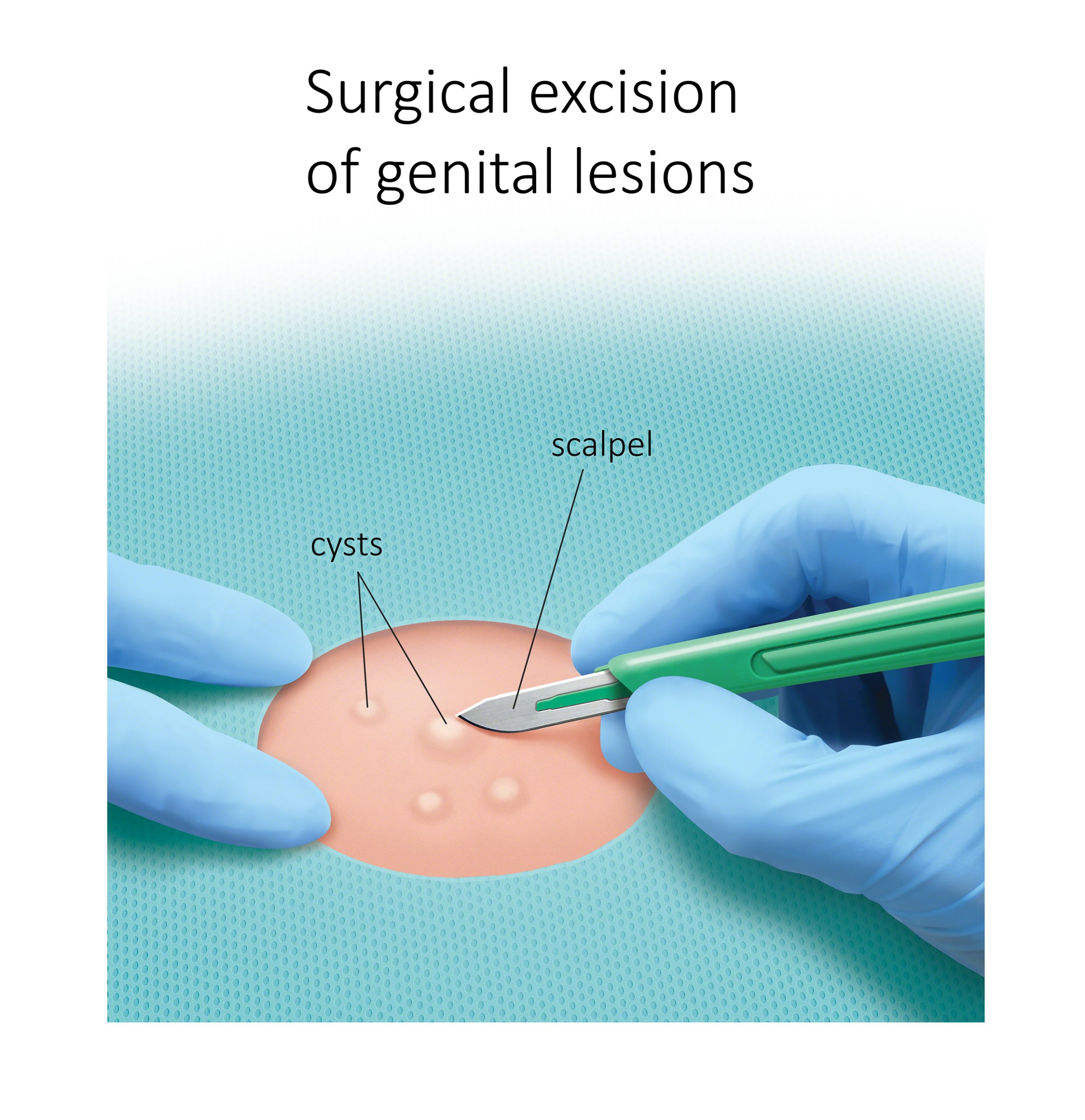 Surgical excision of genital lesions