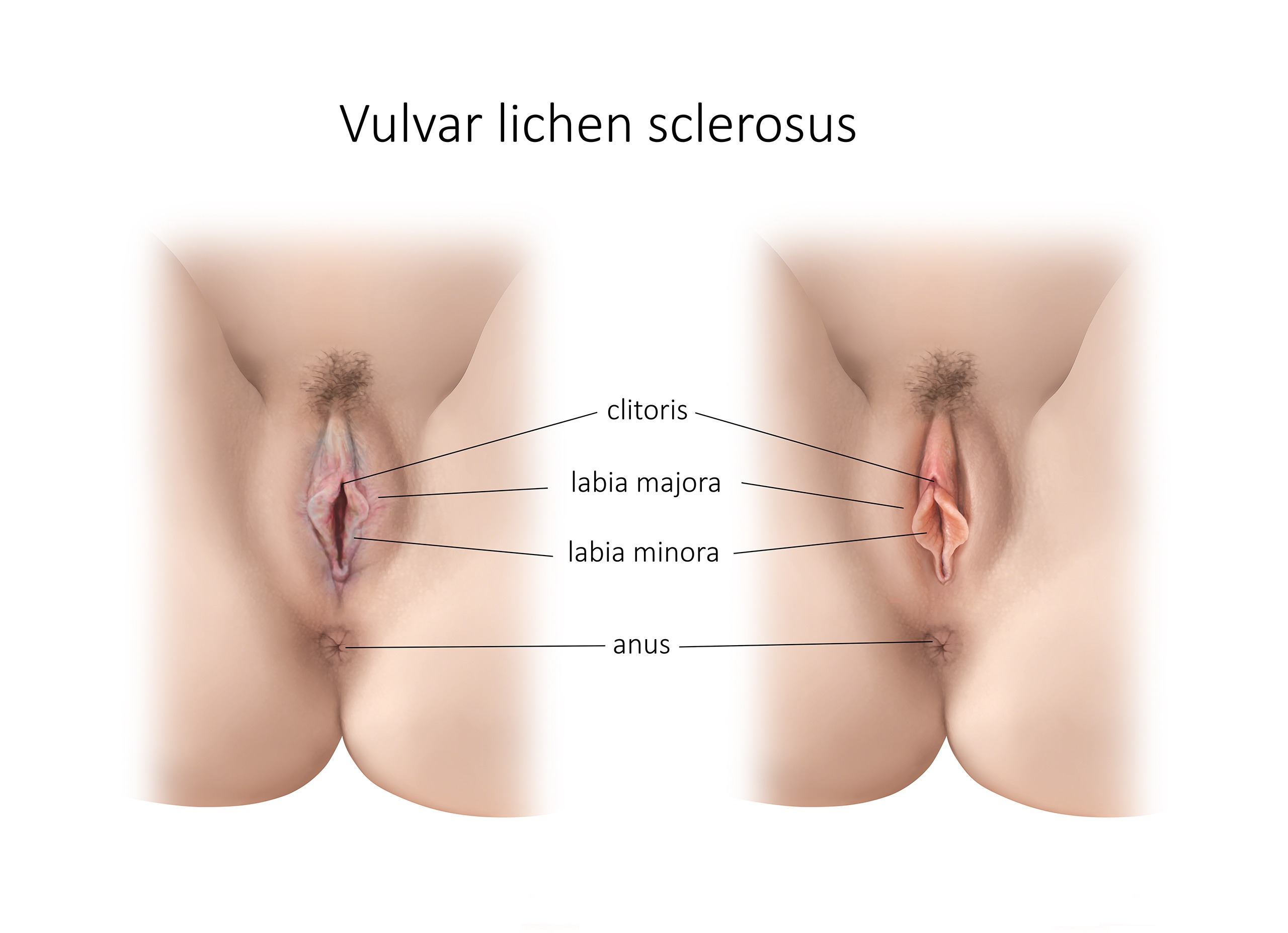 Vulvar Lichen Sclerosus