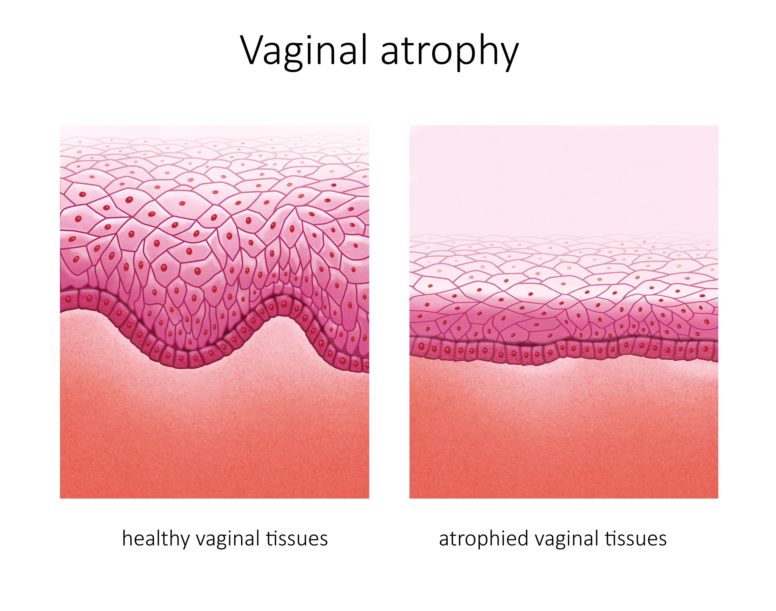 Vulvar Atrophy