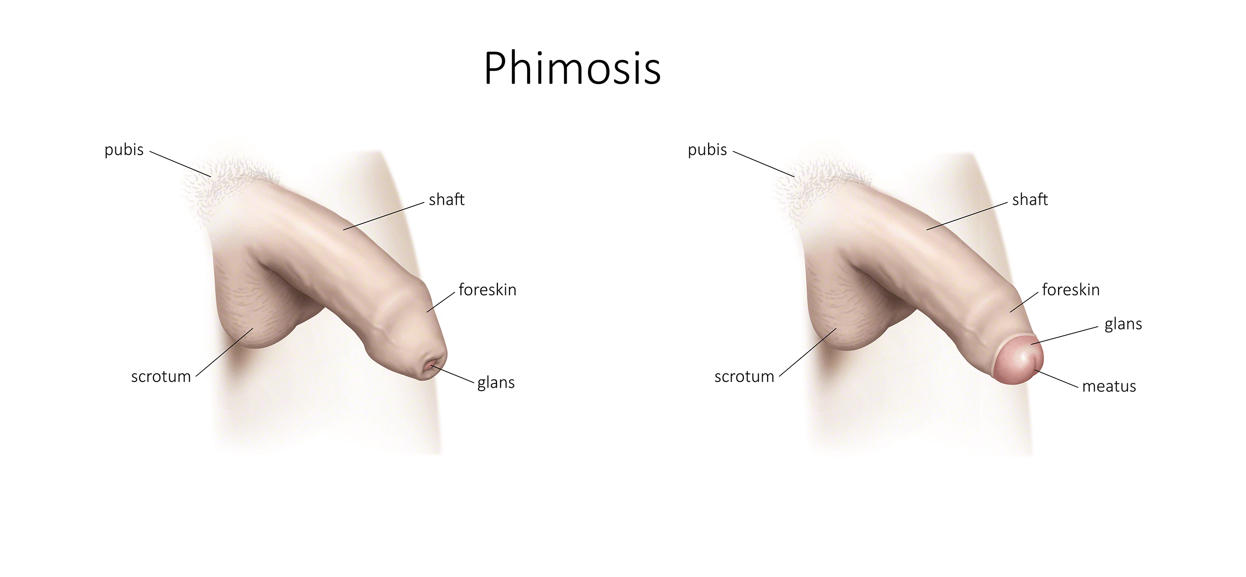 Phimosis Treatment without surgery, Causes