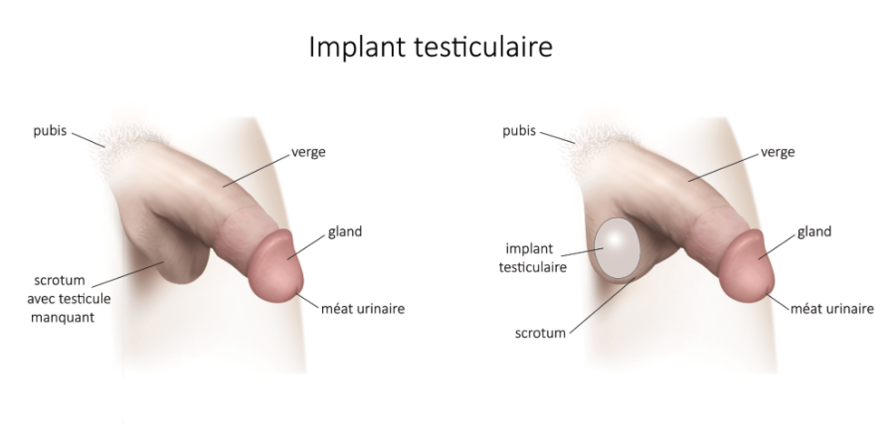 Implant testiculaire