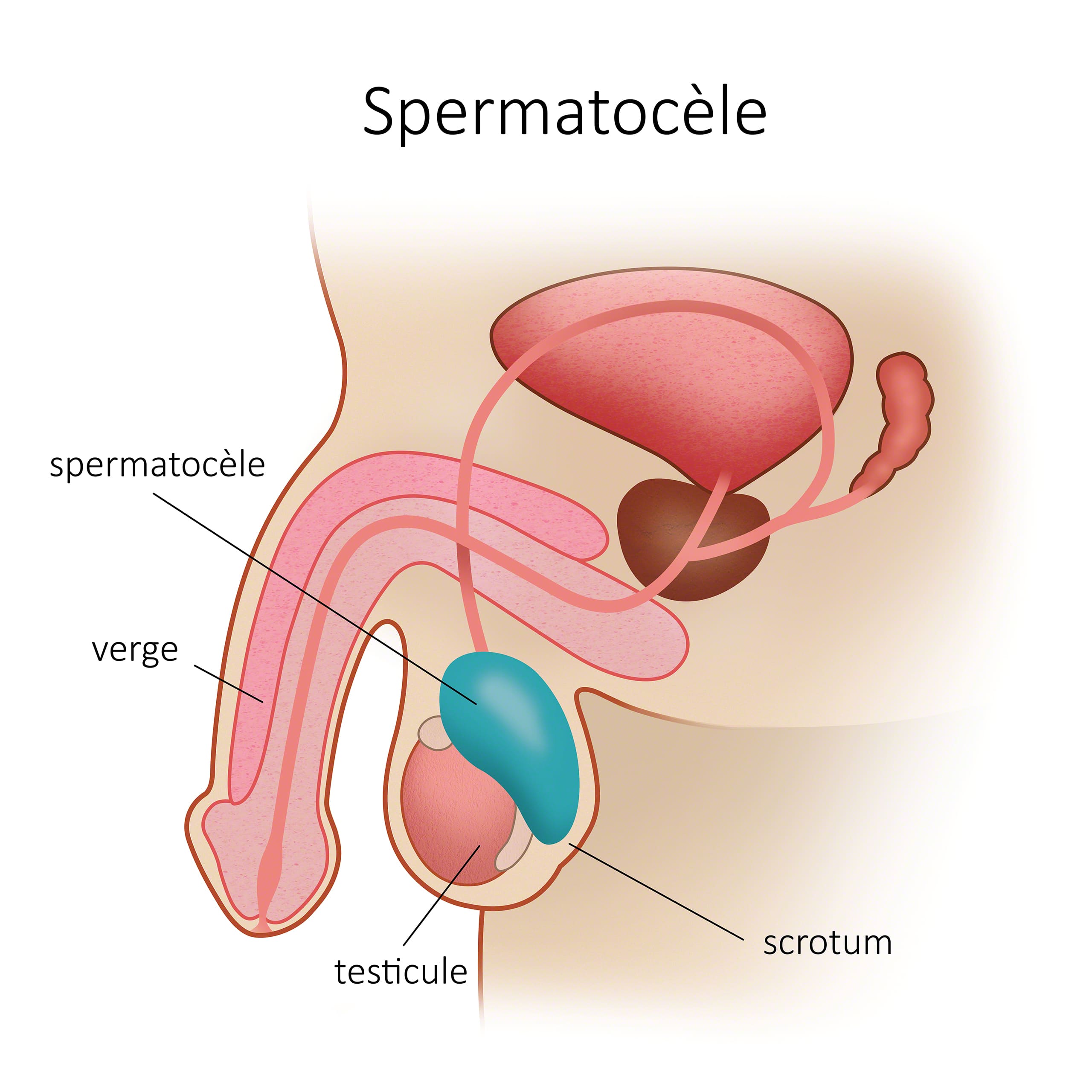 spermatocèle