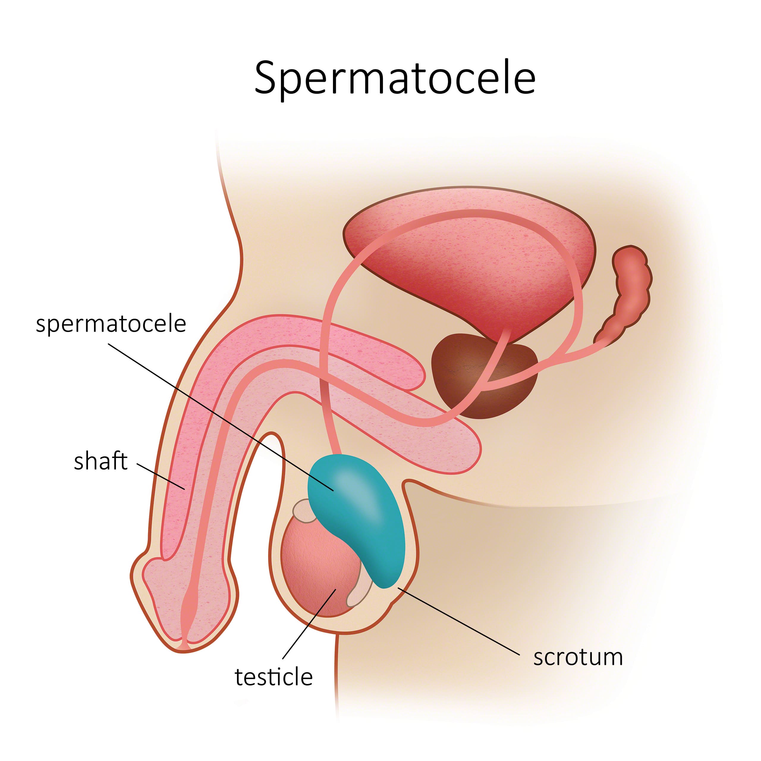 spermatocele
