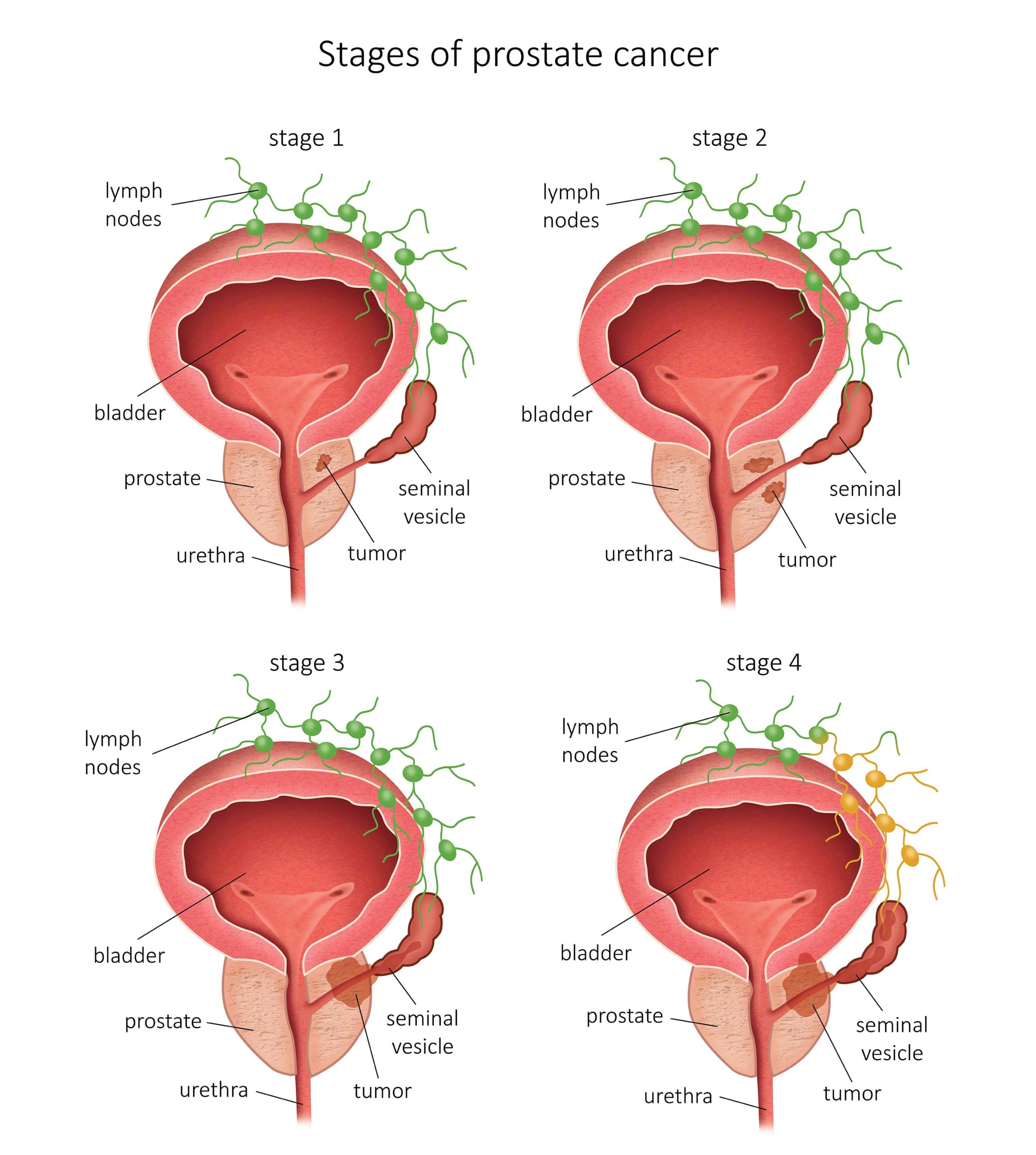 Prostate Biopsy by Transrectal Route