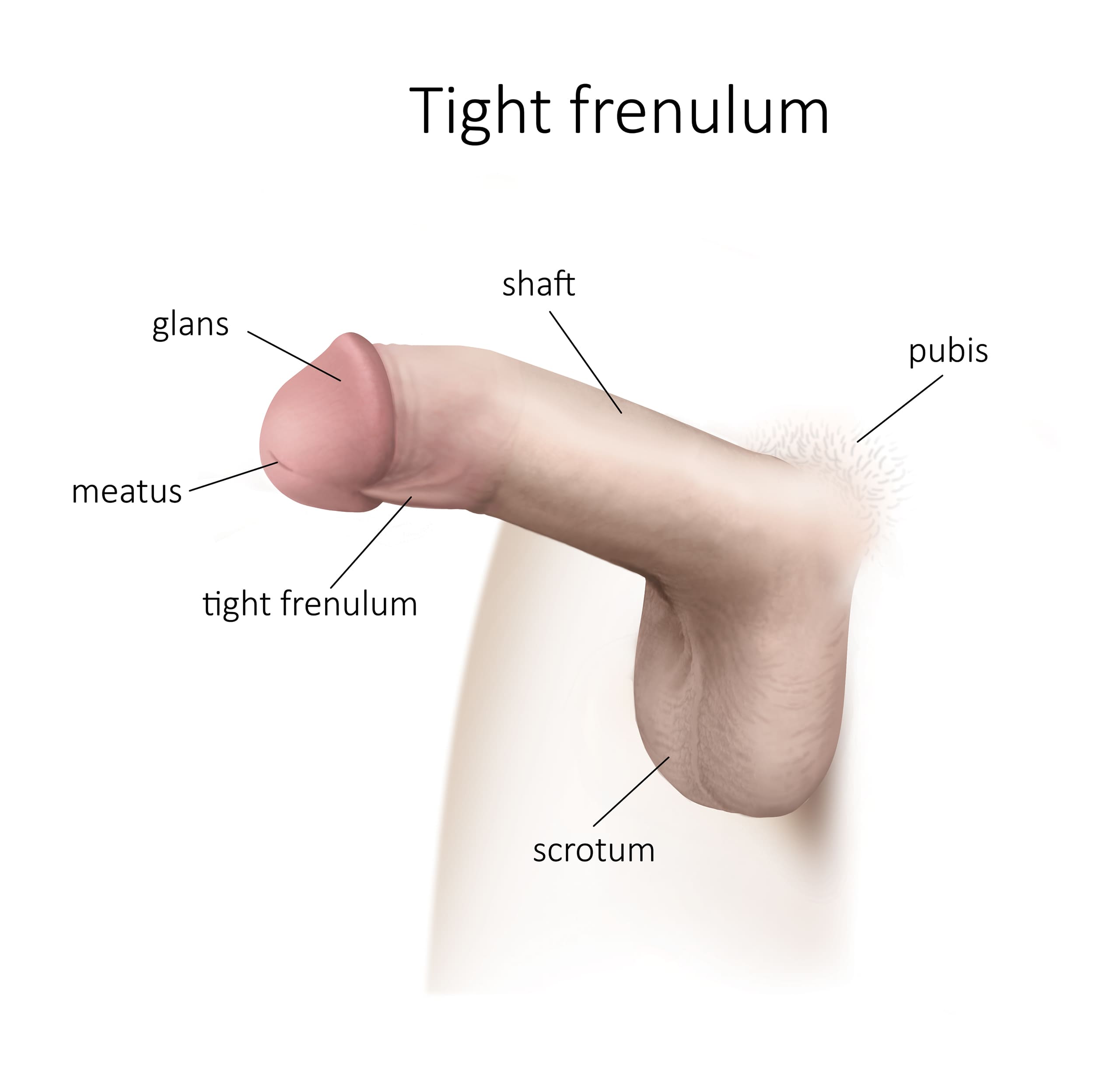Frenectomy or lengthening of the penile frenulum